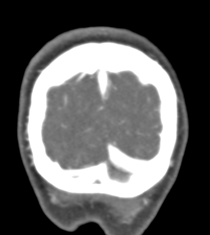 Basilar tip aneurysm with coiling (Radiopaedia 53912-60086 B 150).jpg