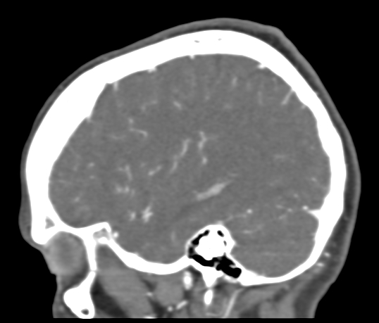 Basilar tip aneurysm with coiling (Radiopaedia 53912-60086 C 103).jpg