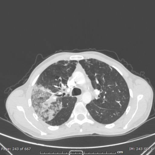 File:Behçet disease (Radiopaedia 44247-47889 Axial lung window 29).jpg