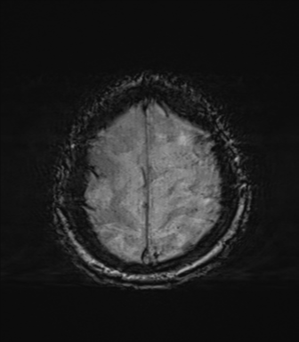 File:Behavioral variant frontotemporal dementia and late onset schizophrenia (Radiopaedia 52197-58083 Axial SWI 69).png