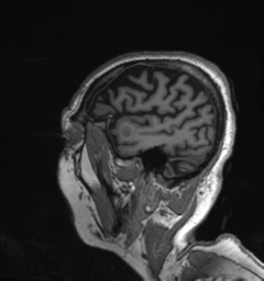 Behavioral variant frontotemporal dementia and late onset schizophrenia (Radiopaedia 52197-58083 Sagittal T1 4).png