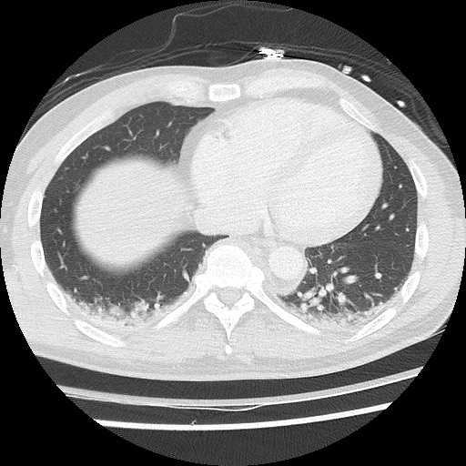 Benign post-traumatic pseudopneumoperitoneum (Radiopaedia 71199-81495 Axial lung window 51).jpg