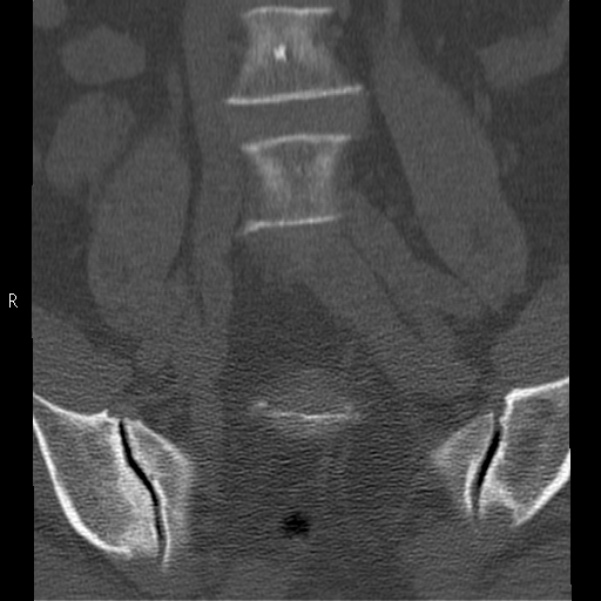 Bertolotti syndrome (Radiopaedia 24864-25128 Coronal bone window 9).jpg