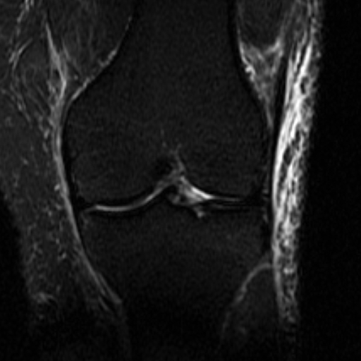File:Biceps femoris distal tendon avulsion (Radiopaedia 15109-14987 Coronal STIR 1).jpg