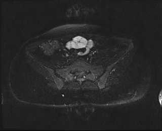 File:Bicornuate bicollis uterus (Radiopaedia 61626-69616 Axial PD fat sat 6).jpg