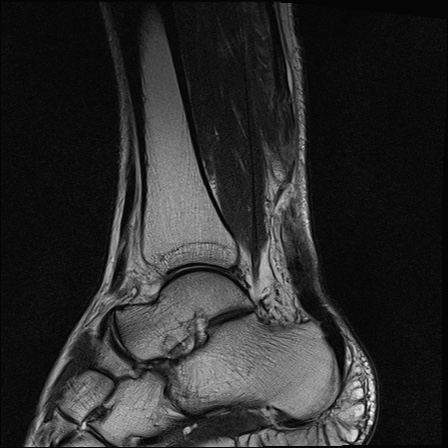 File:Bilateral Achilles tendon complete tear (Radiopaedia 81344-95051 Sagittal T2 22).jpg
