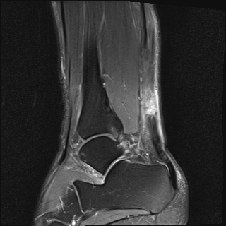 File:Bilateral Achilles tendon complete tear (Radiopaedia 81344-95051 Sagittal T2 fat sat 6).jpg