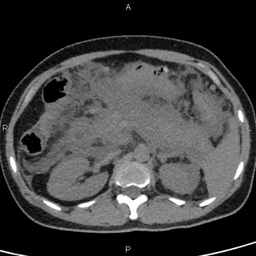 Bilateral adrenal gland hyperenhancement in pancreatitis (Radiopaedia 86642-102753 Axial non-contrast 43).jpg