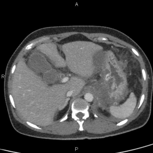Bilateral adrenal gland hyperenhancement in pancreatitis (Radiopaedia 86642-102753 E 23).jpg