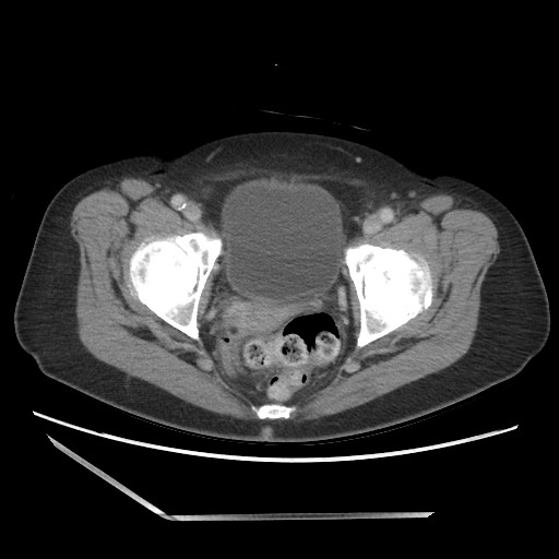 Bilateral adrenal granulocytic sarcomas (chloromas) (Radiopaedia 78375-91007 A 110).jpg