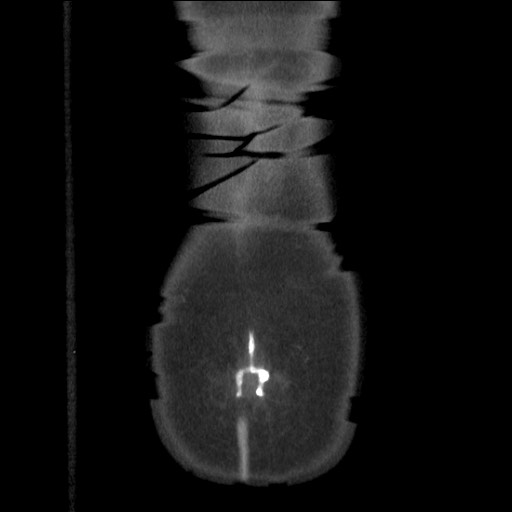 Bilateral adrenal granulocytic sarcomas (chloromas) (Radiopaedia 78375-91007 B 90).jpg
