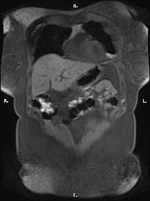 Bilateral adrenal myelolipoma (Radiopaedia 63058-71537 Coronal T1 fat sat 86).jpg
