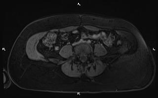 Bilateral adrenal myelolipoma (Radiopaedia 63058-71537 G 76).jpg