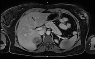 Bilateral adrenal myelolipoma (Radiopaedia 63058-71537 H 30).jpg