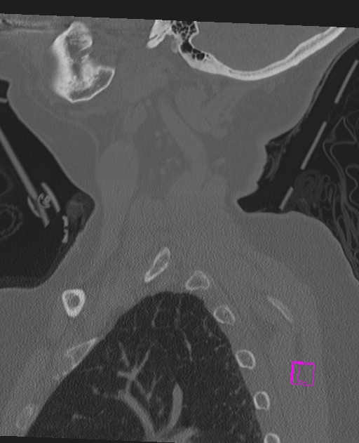 Bilateral atlanto-occipital assimilation (Radiopaedia 28350-28603 Sagittal bone window 12).jpg