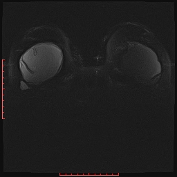 File:Bilateral breast implant rupture (Radiopaedia 24761-25027 PASTA Si IR 21).jpg