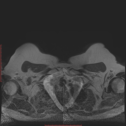 File:Bilateral breast implant rupture (Radiopaedia 24761-25027 T1 1).jpg