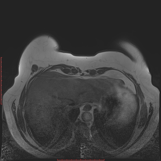 File:Bilateral breast implant rupture (Radiopaedia 24761-25027 T1 33).jpg