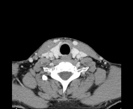 Bilateral carotid body tumors (Radiopaedia 61841-69870 Axial Post contrast 88).jpg
