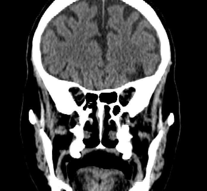Bilateral ectopia lentis (Radiopaedia 89889-107013 Coronal non-contrast 93).jpg