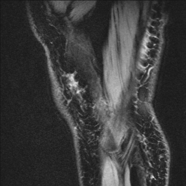 Bilateral focal pigmented villonodular synovitis (Radiopaedia 67643-77046 G 61).jpg
