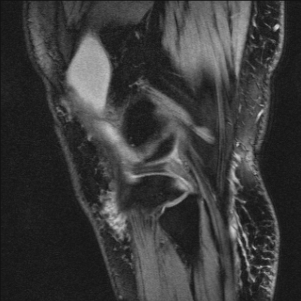 Bilateral focal pigmented villonodular synovitis (Radiopaedia 67643-77073 Sagittal T1 vibe 12).jpg
