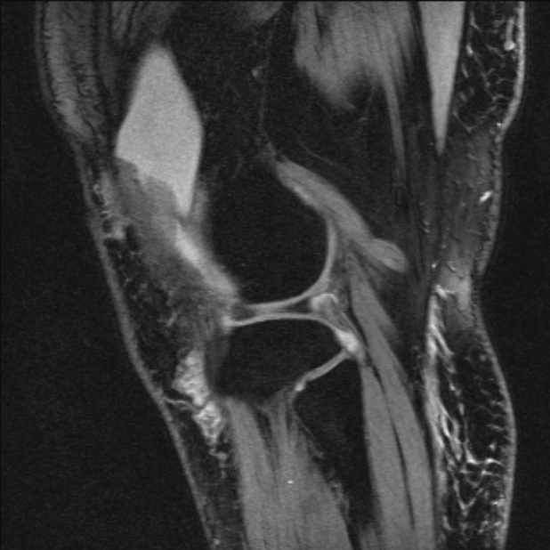 Bilateral focal pigmented villonodular synovitis (Radiopaedia 67643-77073 Sagittal T1 vibe 14).jpg