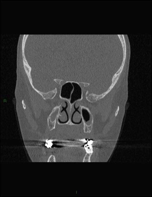 Bilateral frontal mucoceles (Radiopaedia 82352-96454 Coronal 191).jpg