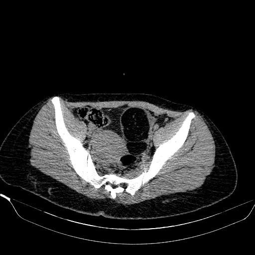 File:Bilateral ovarian dermoid (Radiopaedia 45714-49907 Axial non-contrast 22).JPEG