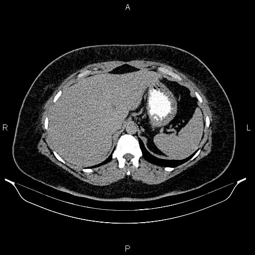 Bilateral ovarian dermoid cysts (Radiopaedia 85785-101603 Axial C+ delayed 10).jpg