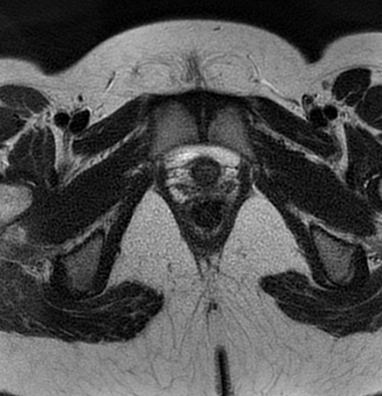 File:Bilateral ovarian fibrothecomas - adolescent (Radiopaedia 86604-102707 Axial T2 43).jpg