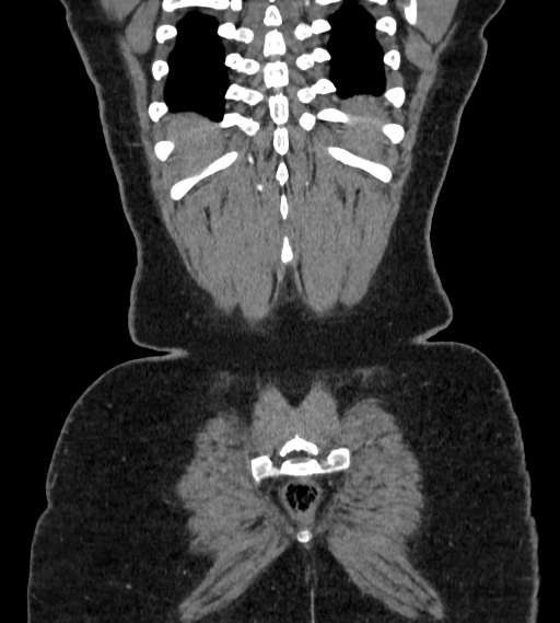 Bilateral ovarian mature cystic teratomas (Radiopaedia 79373-92457 B 104).jpg