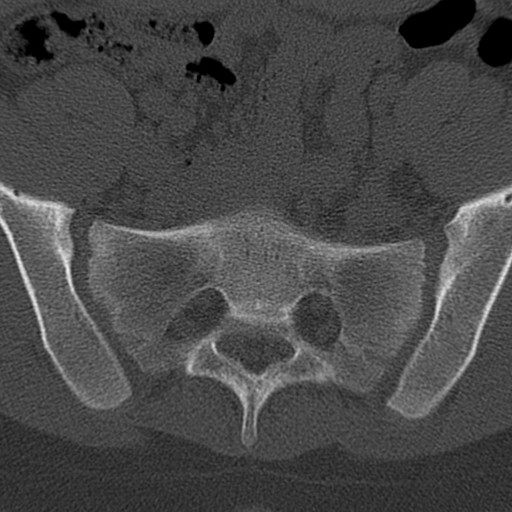 Bilateral pars defect (Radiopaedia 26691-26846 Axial bone window 90).jpg