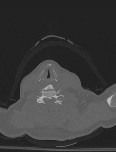 File:Bilateral perched facet joint (Radiopaedia 63149-71669 Axial bone window 43).jpg