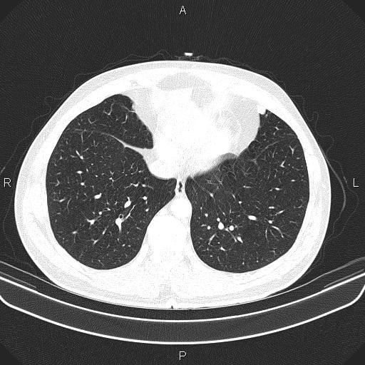 File:Bilateral pulmonary AVM (Radiopaedia 83134-97505 Axial lung window 55).jpg