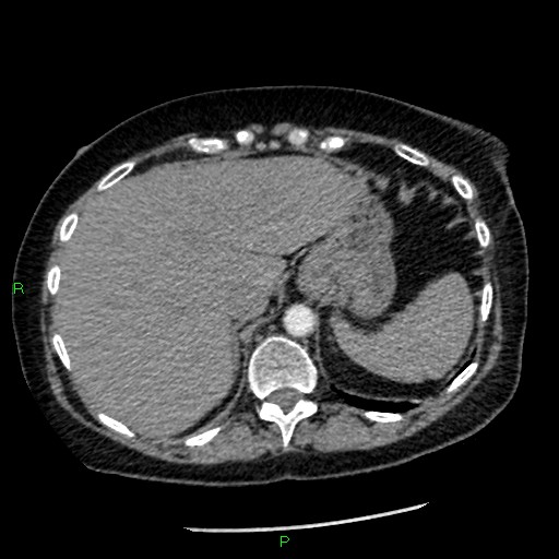 Bilateral pulmonary emboli (Radiopaedia 32700-33669 Axial C+ CTPA 98).jpg