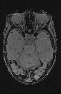 Bilateral subdural hemorrhage and parietal skull fracture (Radiopaedia 26058-26190 Axial SWI 22).png