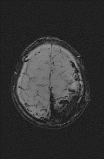 Bilateral subdural hemorrhage and parietal skull fracture (Radiopaedia 26058-26190 Axial SWI 71).png