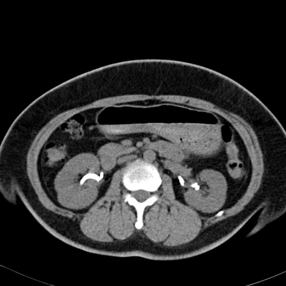 Bilateral ureteric stents (Radiopaedia 48795-53825 Axial non-contrast 24).jpg