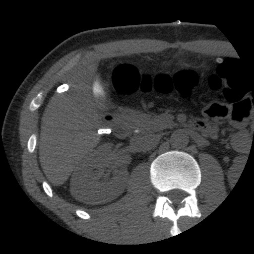 File:Bile leak from liver traumatic laceration (Radiopaedia 63463-72077 Axial Biliscopin 59).jpg
