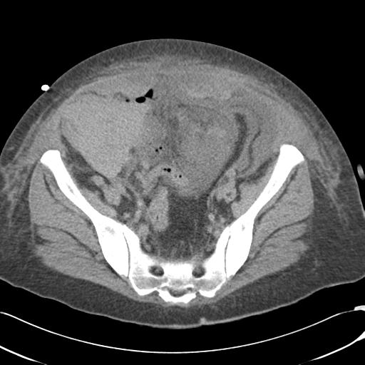 Bladder rupture post renal biopsy (Radiopaedia 30863-31572 Axial non-contrast 68).jpg