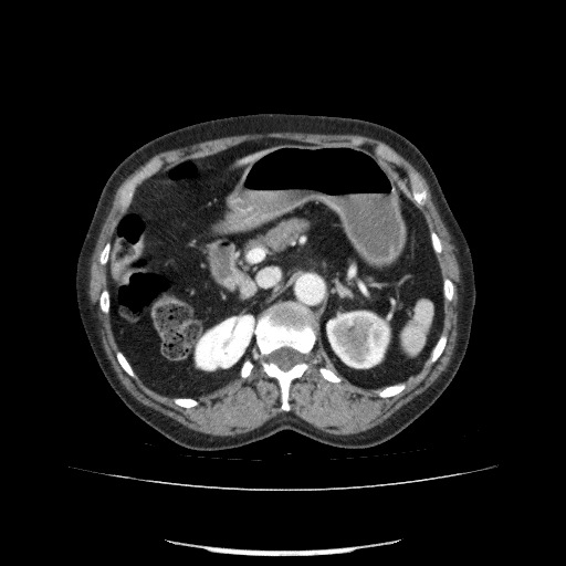 File:Bladder tumor detected on trauma CT (Radiopaedia 51809-57609 B 44).jpg