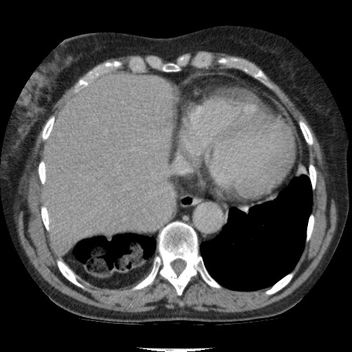 Bladder tumor detected on trauma CT (Radiopaedia 51809-57609 C 17).jpg