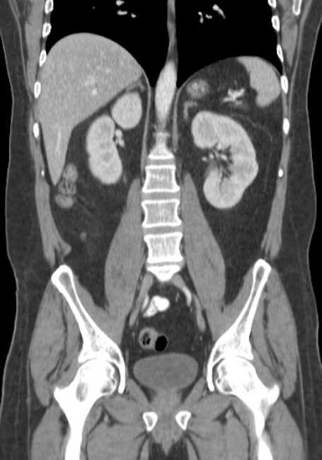 Bleeding duodenal ulcer and adenomyomatosis of gallbladder (Radiopaedia 61834-69861 B 35).jpg