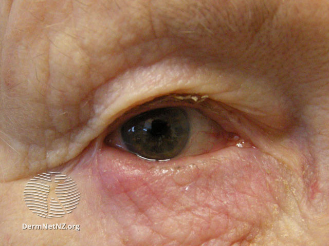 File:Blepharitis due to rosacea (DermNet NZ site-age-specific-blepharitis1).jpg