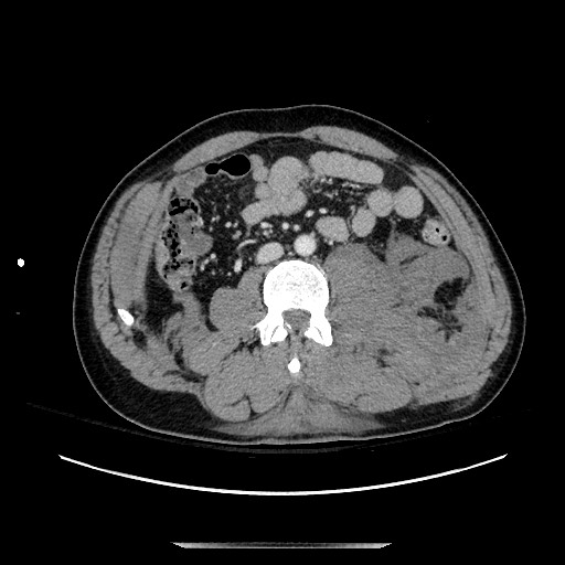 Blunt abdominal trauma with solid organ and musculoskelatal injury with active extravasation (Radiopaedia 68364-77895 A 81).jpg