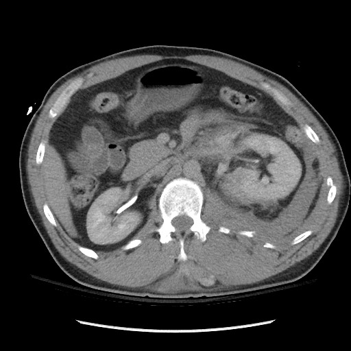 Blunt abdominal trauma with solid organ and musculoskelatal injury with active extravasation (Radiopaedia 68364-77895 Axial C+ delayed 54).jpg