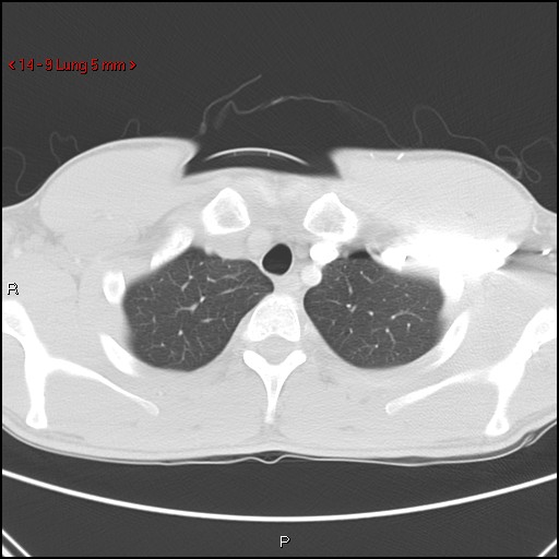 Blunt chest trauma - pulmonary interstitial emphysema and pneumomediastinum (Radiopaedia 20666-20552 Axial lung window 9).jpg
