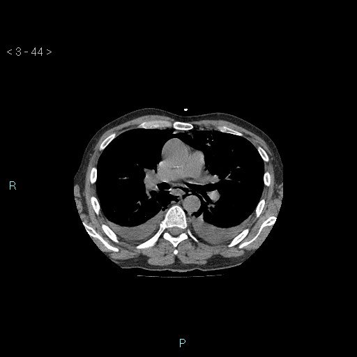 Boerhaave syndrome (Radiopaedia 27683-27897 Axial non-contrast 44).jpg