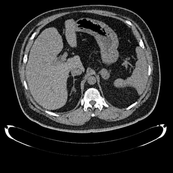 Bosniak renal cyst - type IV (Radiopaedia 24244-24518 Axial non-contrast 109).jpg
